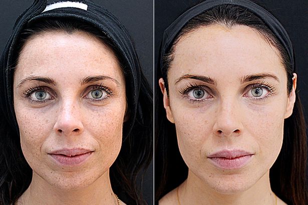 cheek fillers before and after 